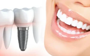 Имплантация зубов — что это и как она происходит, противопоказания
